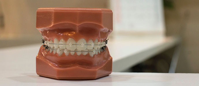 牙齿雕塑上的牙套